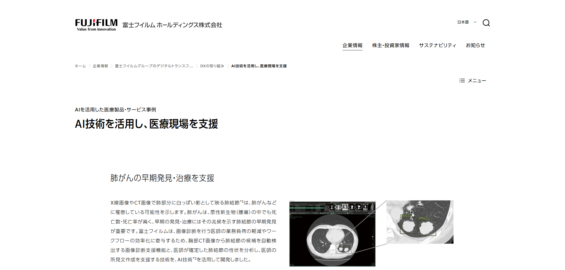 富士フイルム：肺がんのCT画像診断支援AIを開発し、早期発見